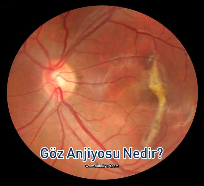 Göz Anjiyosu Nedir